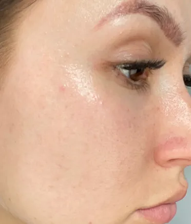 a woman's cheek without acne